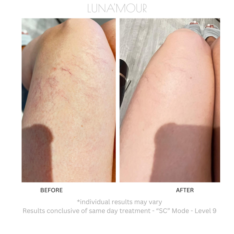 COOL PRO Blemish & Hair Removal System