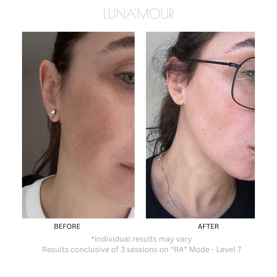 COOL PRO Blemish & Hair Removal, real customer before and after