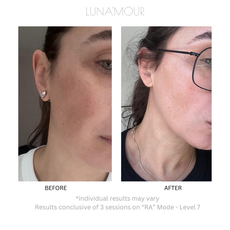 COOL PRO Blemish & Hair Removal System