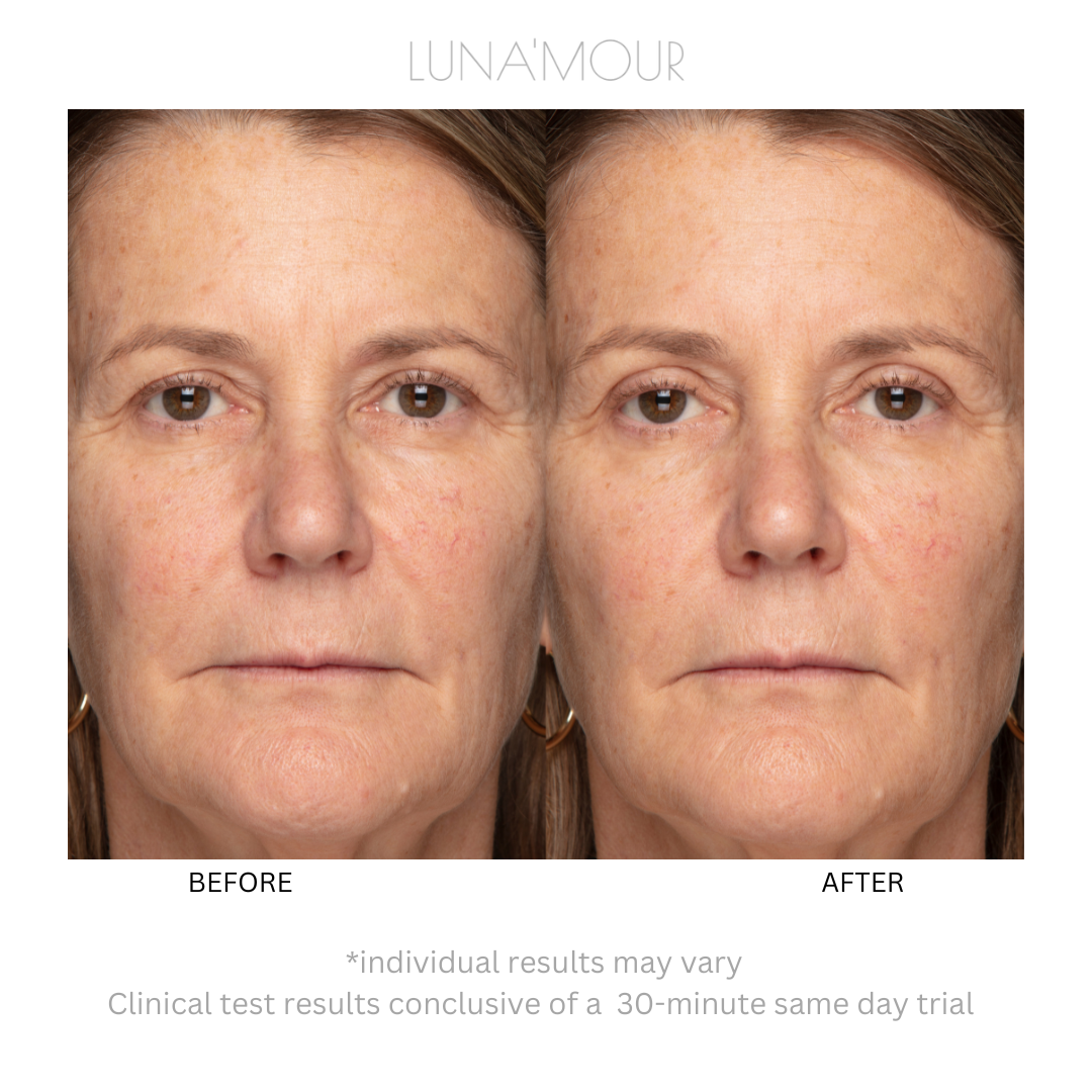 3-in-1 ElectraLume System, real customer before and after