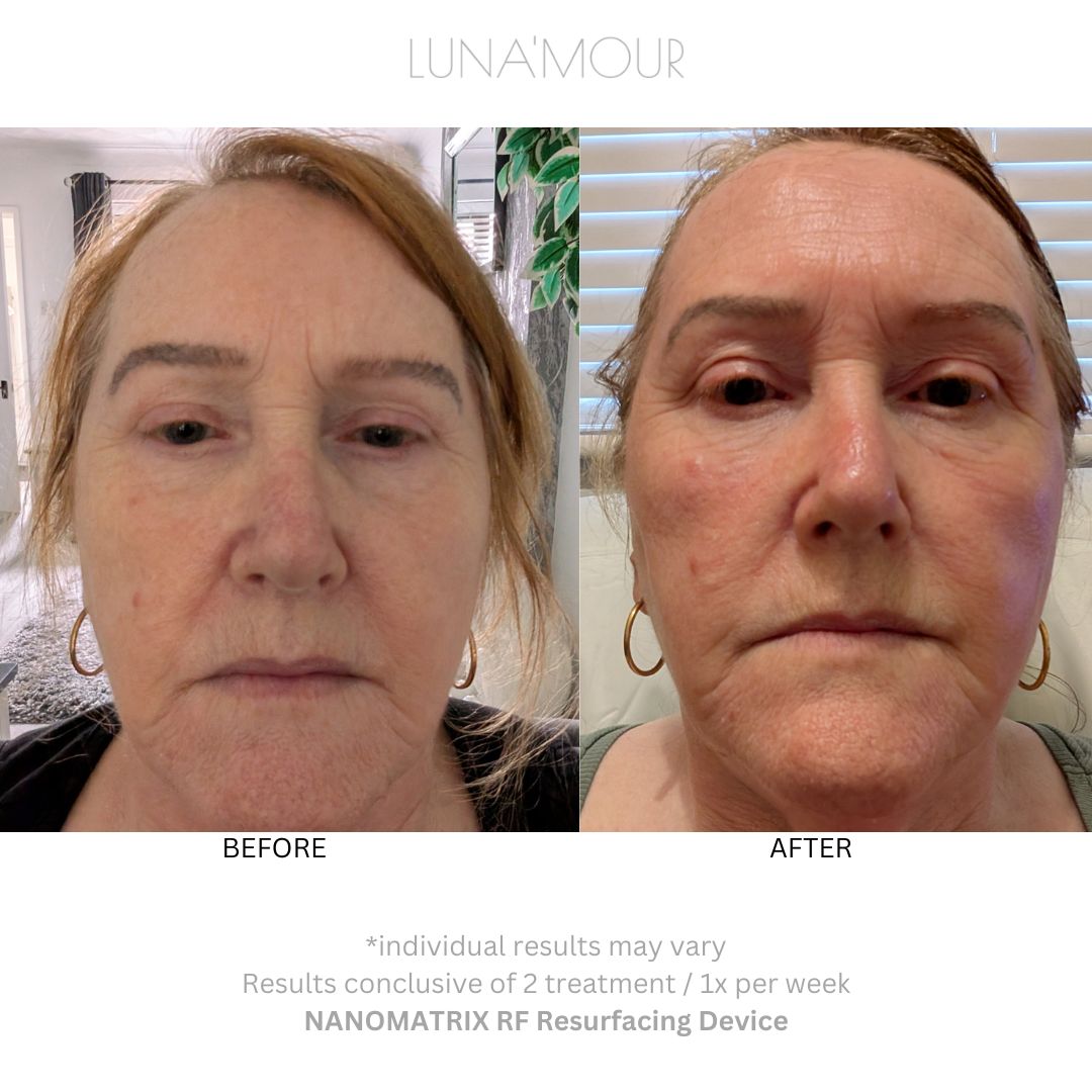 NanoMatrix RF Resurfacing, real customer before and after
