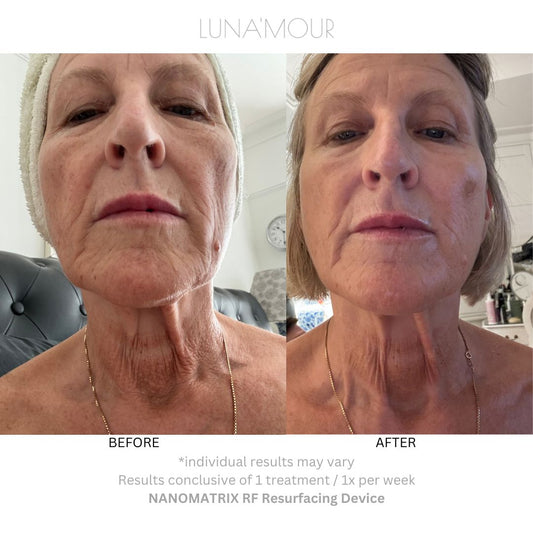 NanoMatrix RF customer before and after, visible improvement in skin clarity, tone and texture