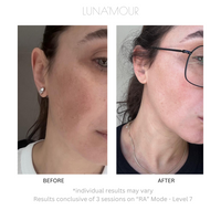 Real customer before and after using the COOL PRO IPL device