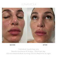 Real customer before and after using the AuraLux Advanced+ LED face mask