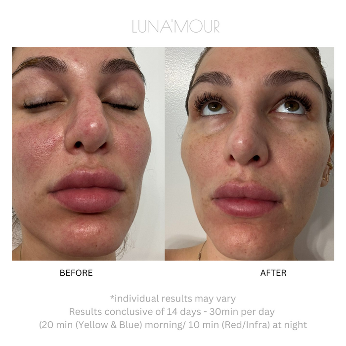 AuraLux Advanced+ — after
