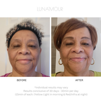 Real customer before and after using the AuraLux Advanced+ LED face mask