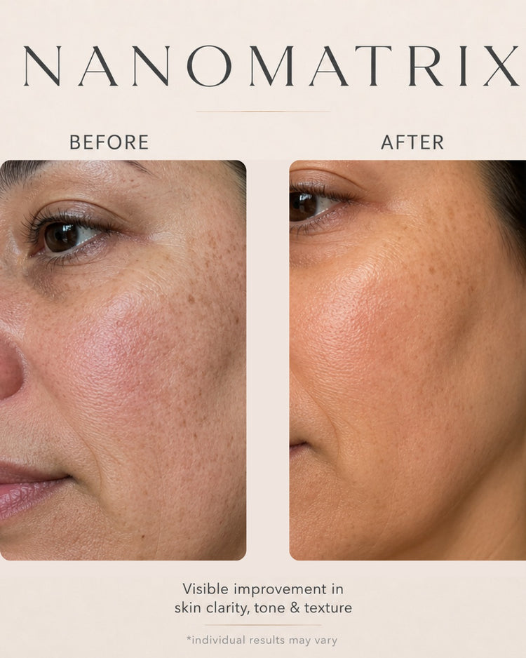 NanoMatrix RF Resurfacing Device Nano MicroNeedling + Fractional Radio Frequency