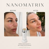 NanoMatrix RF Resurfacing Device Nano MicroNeedling + Fractional Radio Frequency